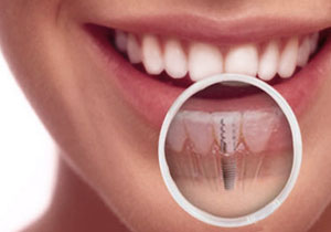 best dentist in reno nv, dental implants reno, reno cosmetic dentist