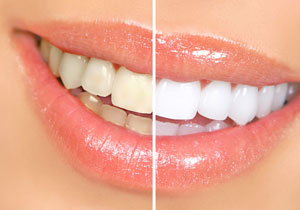 Teeth Whitening