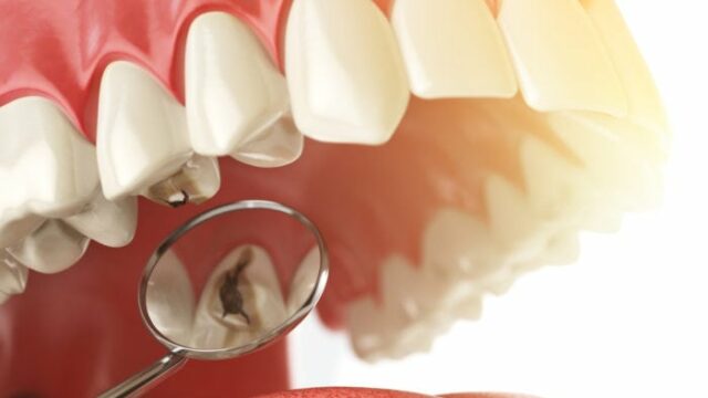 A graphic of a mirror in a mouth with a cavity.